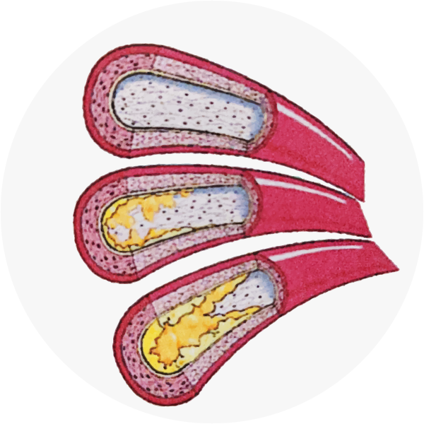 動脈硬化が進むと